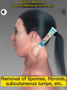 Lipoma Removal Cream: Non-Invasive Treatment & Pain Relief