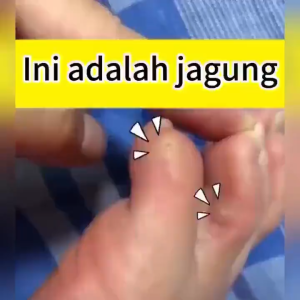 ubat ketuat tapak kaki ketuat remover plaster ketuat wart removal cream Hand Foot Corn Remover corn plaster remover 雞眼貼雞眼藥水雞眼膏肉粒去除