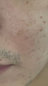 เครื่องดูดสิว สิว สูญญากาศ DERMASUCTION acne ดูดสิว ผิว ผิวหน้า สิวเสี้ยน สิวอุตตัน 1 กล่อง จำนวน 1 เครื่อง ฟรีหัวดูดสิว 4 หัว