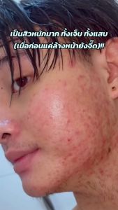 [2pcs]ICELERSKIN กรดซาลิไซลิกเซรั่มกําจัดสิว 10ml