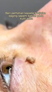 Repairing Black Moles Granulation Skin Flat and Smooth Skin and Removing Warts Care Liquid Pen