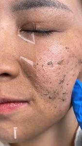 Quarxery Exfoliating Gel 50g Cleans Pores Gently Without Irritation Body Peeling Gel