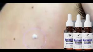 Anti-freckle cream Whitening anti-freckle Essence 30ml/box Lightens spots freckles age spots sun spots Brightens skin tone