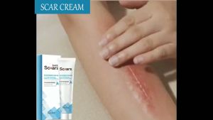 【MY Girl】Scar Removal Cream Peklat Remover Acne Treatment Scar Remover Cream Stretch Mark Cream