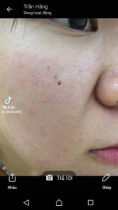 Tiên Tiên Dược- thảo dược giảm mụn hiệu quả