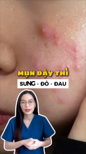 Combo 02 Gel Bôi Mụn Tuổi Dậy Thì YLEE Cho Mụn Trứng Cá Mụn Sưng Đỏ. Hỗ Trợ Giảm Mụn Dưỡng Sáng Da