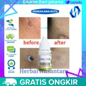 Penghilang Kutil & Tahilalat: Solusi Profesional untuk Mengatasi Masalah Kulit