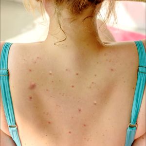 สเปรย์ลดสิวที่หลังเห็นผลเร็ว Greter