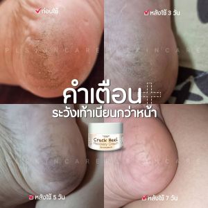 ครีมทาส้นเท้าแตก 🕉 ครีมบำรุงเท้า เท้าแตก เท้าด้าน ขนาด50g. PL Skincare
