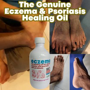 Eczema oil (World Best Chronic Eczema & Psoriasis Healer)