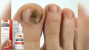 Toenail Fungus Treatment Extra Strong Serum Anti Gray Nails Nail Removal For Thick Discolored Damaged Foot Repair Enhances 15ml