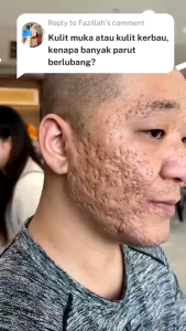 Local Stock] Scar Removal Cream-Stretch Mark Cream-Keloid Scar Remover Hilangkan Parut Jerawat (20g)祛疤膏