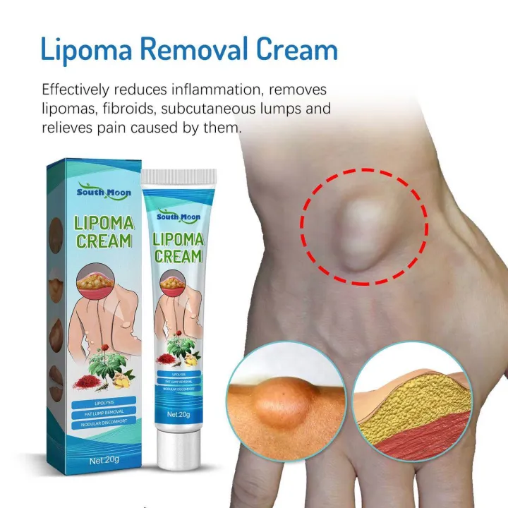 SOUTHMOON%20LIPOMA%20REMOVAL%20CREAM%20krim%20pembersih%20lipoma%20limfa%20ketulan%20keras%20ketiak%20leher%20belakang%20telinga%20buang%20detox%20badan%20-%20Image%207