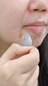 SimplyHeal Best Seller Day & Night Premium Hydrocolloid Acne Patch 16s/20s/40s