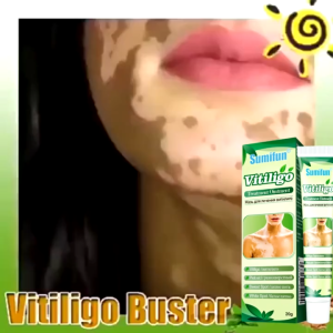 vitiligo treatment cream psoriasis ointment skin white spots pigment melanin mycosis leukoplakia vitiligo homeopathy Regenerating Topical Ointment Krim Kulit Herba Merawat Vitiligo Krim Sapuan Regenerasi Pigmen Pembaikan Tompok Putih