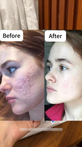 Hi!papa Centella Ampoule Serum - Helps Reduce Acne Repair Skin Fade Dark Spots & Acne Marks 1ml*30ea