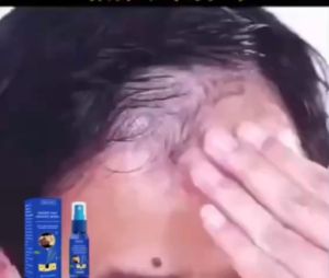 EELHOE Obat Kebotakan Pria - Spray Pertumbuhan Rambut Cepat Hentikan Rontok Parah & Regenerasi Folikel
