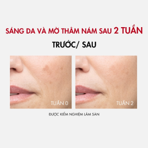 Serum giúp cải thiện & ngăn ngừa thâm nám đốm nâu toàn diện Vichy Liftactiv B3 Dark Spots Serum 30ml Serum Cho Da Nhạy Cảm Vichy Serum Chống Lão Hóa Vichy Liftactiv - Lazada