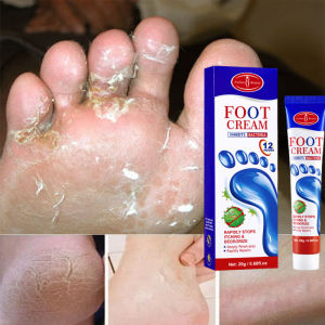 Kem Chống Nấm Chân 20G Dưỡng Ẩm Chăm Sóc Da Giảm Ngứa Thành Phần Thảo Dược Tự Nhiên Để Điều Trị Nhiễm Nấm