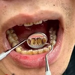 ( 2IN1 ) Pasta Pemutih Gigi Baking Soda + Teeth Charcoal Powder Bersihkan Gigi Kuning dalam 7 Hari