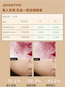 Humeili Grass Anti-Acne Repair Anti-Acne Essence Anti-Blackness Dark Shrink Pores Closed Mouth Acne Oil Control Mask