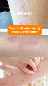 MyLO ScratchGuard Relief Patch (10 patches / pouch) - Hydrocolloid & Pro-Vitamin B5