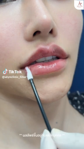 ฟิลเลอร์ Neuramis กล่องดำ ฟิลเลอร์ตัวดังจากเกาหลี Alyn clinic อลินคลินิก