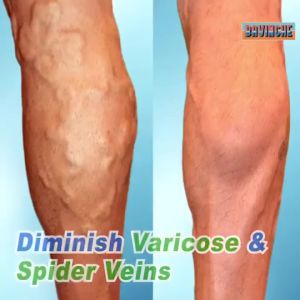 Swelling Reduction & Vein Care Cream: Effective Treatment for Phlebitis, Spider Veins & More