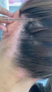 anti dandruff shampoo shampoo kelemumur dandruff treatment oil control sea salt Shampoo syampoo kelemumur syampu 去屑洗发露 Deep clean scalp reduce dandruff hair treatment removes mites Scalp Care scalp psoriasis Relieve itchy scalp Bald