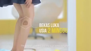 Kem phục hồi loại bỏ sẹo Xóa sẹo chống ngứa và đau