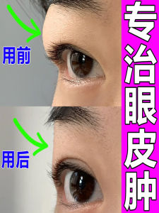 Swelling Eye Bubble Removing Swelling Eye Allergy Edema Eyelid Detumescence Handy Gadget Eyes Staying up Late Red Swelling Inflammation Special Anti-Fat Patch