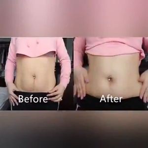 Stretch Mark Removal Cream Remover Scar Gel Stretch mark lotion effectively remove postpartum stretch marks and obesity lines firm the body