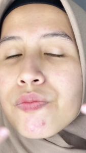 Whitelab Acne Toner - Toner Untuk Kulit Jerawat bpom