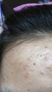 LANBENA Pimple Acne Patch
