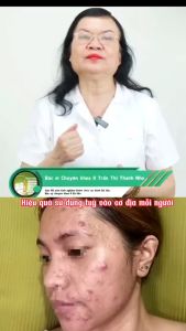 [Chính hãng]Serum giảm mụn thâm-Serum acnes ampoule Maderma+