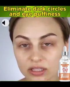 Fat granule remover Eye cream Eye removing magic device to remove fat particles Syringoma eye surrounding small granulation miliaria papule essence 30ml 脂肪粒去除