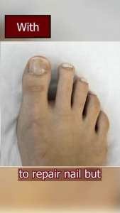 nail fungus treatment serum Nail Fungus Repair Spary Nail Fungal Treatment Quickly Repair Damaged Effective Fungus Removal Anti-Fungal Foot Nail Care 靓甲护理液30ml