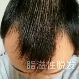 Shampo Penumbuh Rambut Cepat Anti rambut rontok Botak ginger shampoo 500ml Botak Rontok Penumbuh Rambut Perawatan Hair Care Treatment Anti