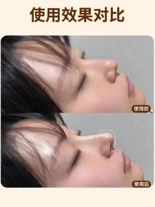 Thermoplastic Nasal Splint Low Temperature Self-Pinch Correction Shaping Nose Post-Operation Fixator Nasal Wing Reduction Handy Gadget Splint Genuine Goods