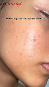 Yukazan Derma Refining Cream Acne & Pore 30ml Acne Removal | Jerawat