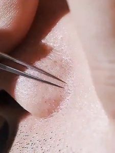 8pcs Stainless Steel Acne Clip/Stainless Steel black heads remover tools set With Box/Acne Clip Cell Tweezers Blackhead Remover Comedone Kit.