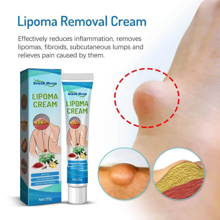 SOUTHMOON%20LIPOMA%20REMOVAL%20CREAM%20krim%20pembersih%20lipoma%20limfa%20ketulan%20keras%20ketiak%20leher%20belakang%20telinga%20buang%20detox%20badan%20-%20Image%202