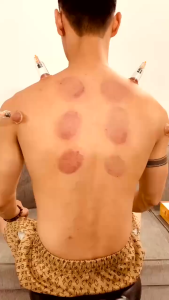 PVN75141 Bộ Cốc Giác Hơi Không Dùng Lửa 12 Chiếc – Dụng Cụ Massage Giác Hơi An Toàn Dễ Thao Tác