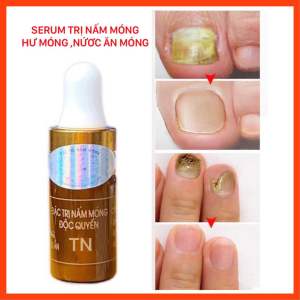 SERUM NẤM MÓMG ( mẫu mới)