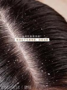 ORGINESE | Cleanse Follicle Dandruff Relief Itch Relief Oil Control Volumizing Shampoo