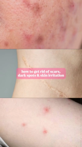 Scarminator Cream by Skin Sensation 40g Best Scar Remover