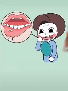 Mouth Ulcer Gel Quickly Repair Mouth Ulcer Wound Relieve Pain Fresh Breath 20g Treats Tongue Ulcers Gum Ulcers Lip Ulcers Mouth Ulcers Inner Mouth Ulcers Adults and Children Mouth Ulcers Inflammation are available.