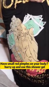 Acne Body Wash Eczema Kulit Gatal Acne Mites Anti Itch Shower Gel Amino Acid Whitening Body Melanin Body Wash Goose Bumps Itchy Skin Anti-Mite Shower Gel Amino Acid Shower Gel antibacterial Mite removal 350ml Personal Care Can inhibit mites