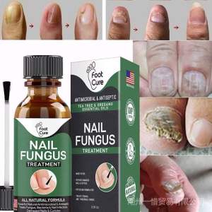 NAIL FUNGUS TREATMENT Rawatan Kuku nail repair penghapus kulat kuku baiki kuku rosak hitam kuning