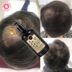 Shampoo Penumbuh Rambut 300ml: Solusi Rambut Romtok & Botak